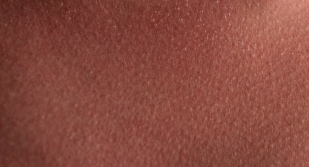 A close-up of facial redness and flushing that BroadBand Light (BBL) calms, at a Thonotosassa, FL medical spa