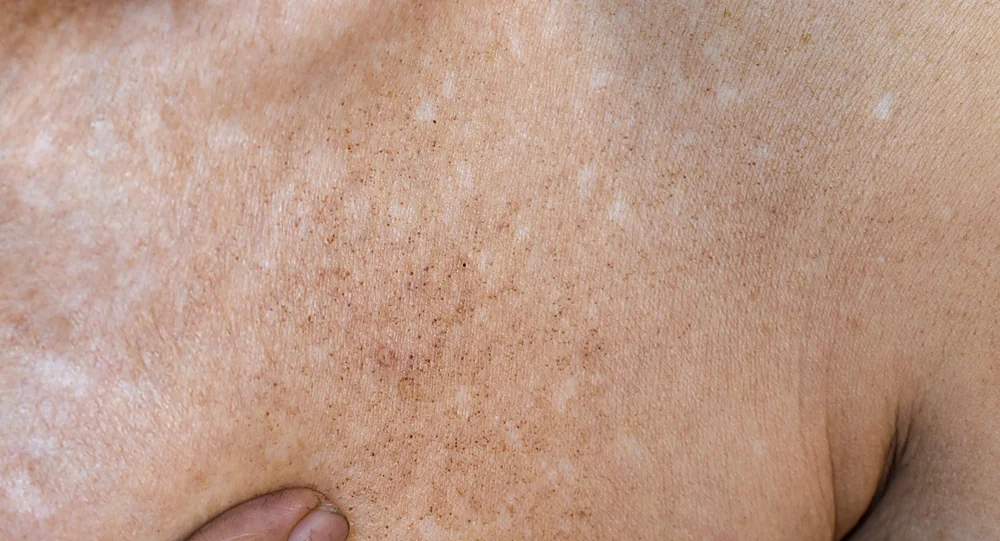 A close-up of sun damage and brown spots on the skin that BroadBand Light (BBL) fades, at a Thonotosassa, FL medical spa
