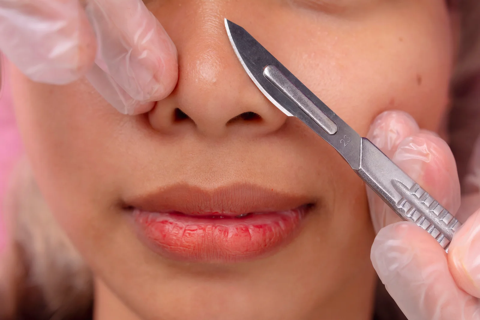 A licensed esthetician performing dermaplaning with a sterile blade at SpaRx Medical Aesthetics in Thonotosassa, FL