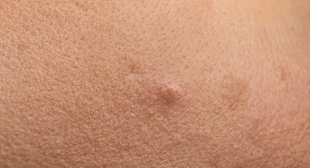 A close-up of acne-prone skin that LED light therapy helps calm, at a Thonotosassa, FL medical spa