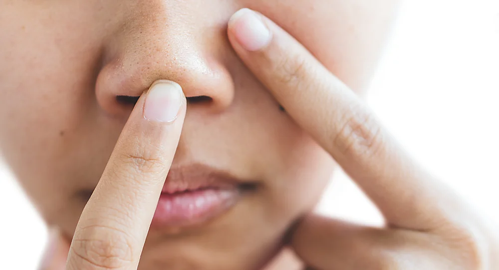 A close-up of congested skin and blackheads that a Deep Cleaning Hydro Facial clears, at a Thonotosassa, FL medical spa