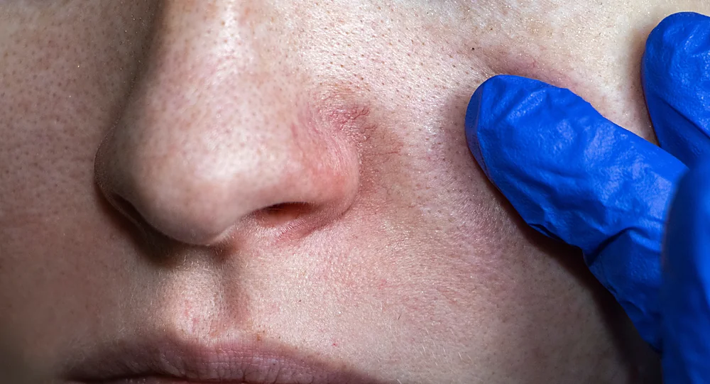 A close-up of broken capillaries and small visible vessels near the nose that an IPL photofacial targets, at a Thonotosassa, FL medical spa
