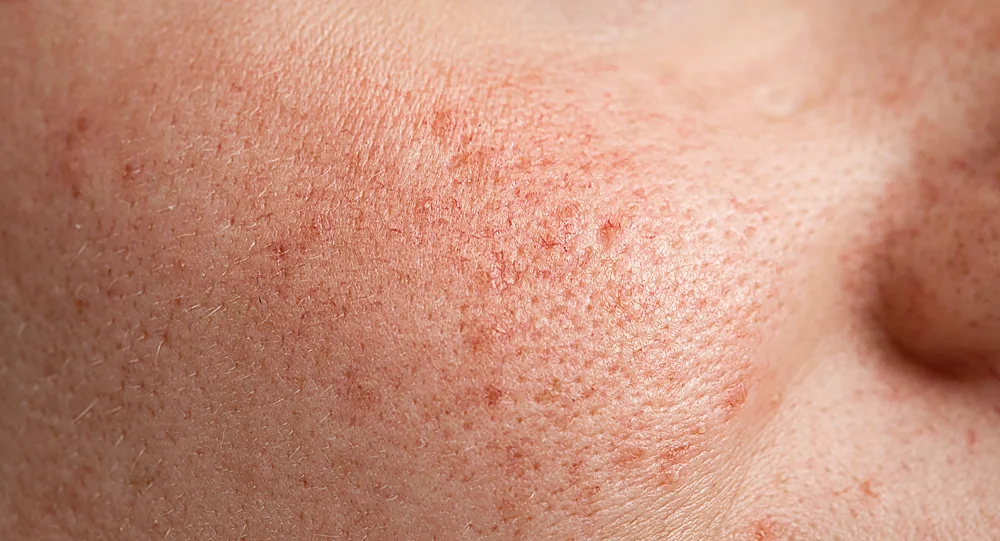 A close-up of facial redness and sensitive skin that LED light therapy helps calm, at a Thonotosassa, FL medical spa