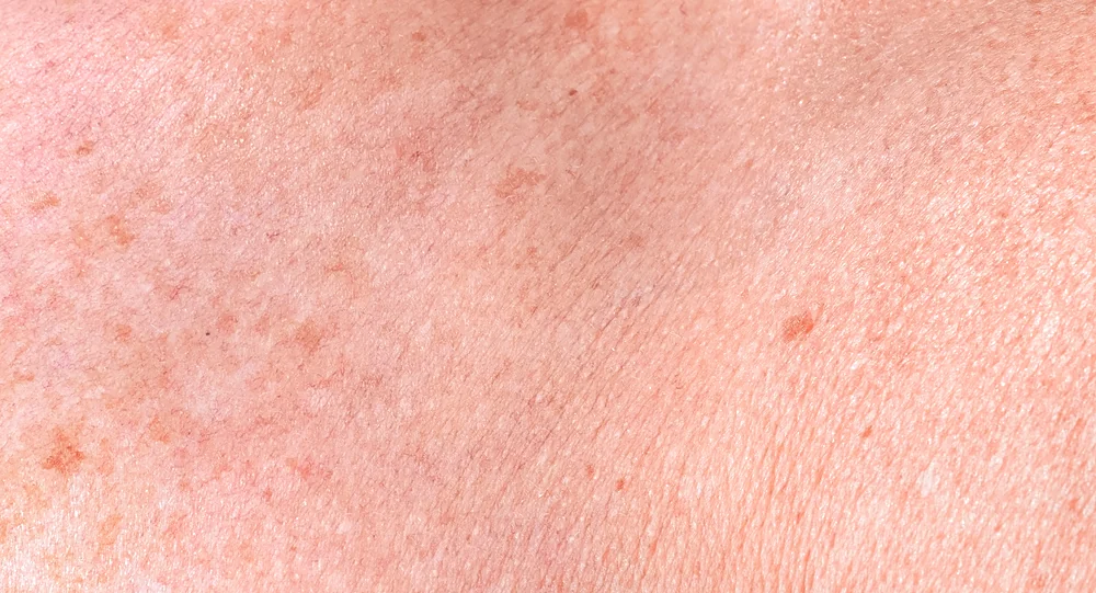 A close-up of sun spots and uneven brown pigment on the skin that an IPL photofacial fades, at a Thonotosassa, FL medical spa