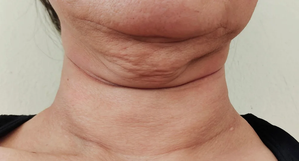A close-up of loose, lax skin on the neck that Jet Plasma skin tightening helps firm, at a Thonotosassa, FL medical spa