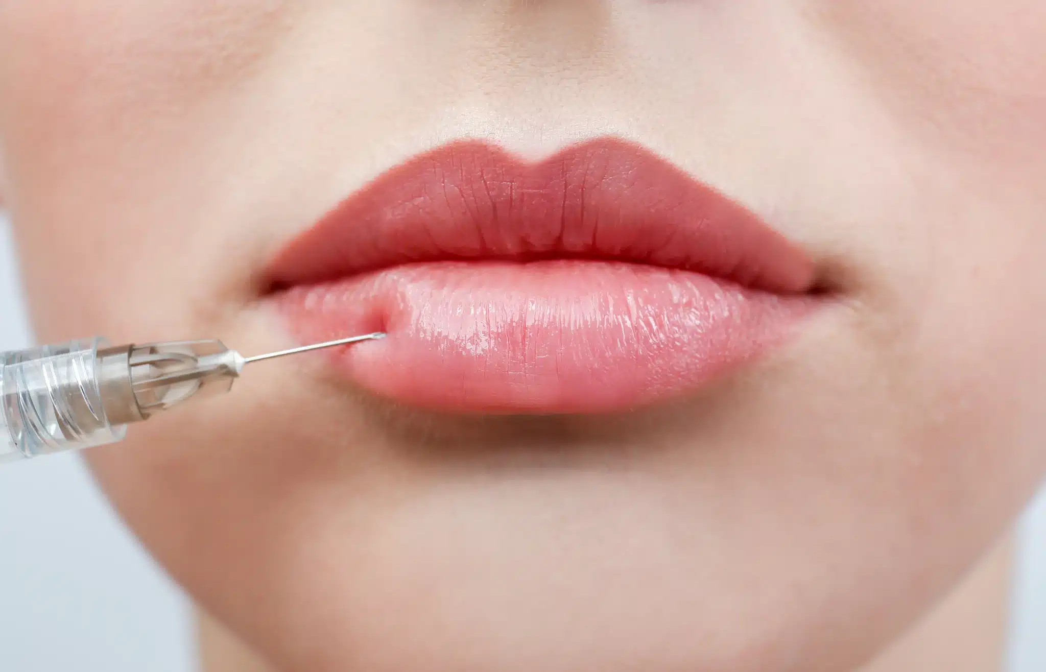 A close-up of a lip flip treatment, with a fine needle placed along the upper lip border at SpaRx Medical Aesthetics in Thonotosassa, FL.