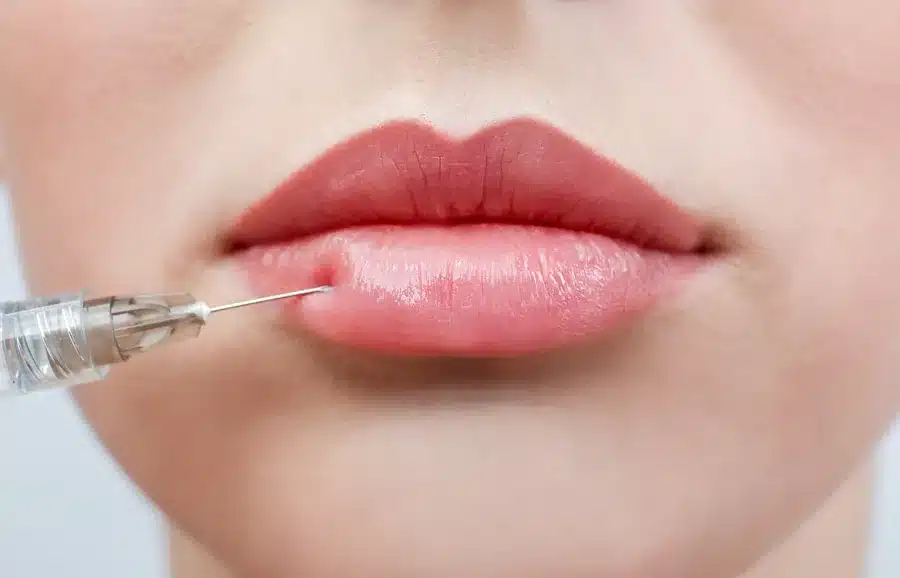 A certified injector performing a lip flip with a fine-needle injection at the lip at SpaRx Medical Aesthetics in Thonotosassa, FL