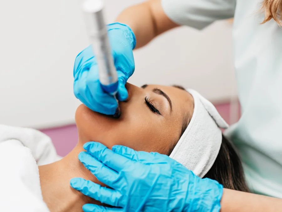 Microneedling with PRP being performed on a patient's face for a Vampire Facial at SpaRx Medical Aesthetics in Thonotosassa, FL