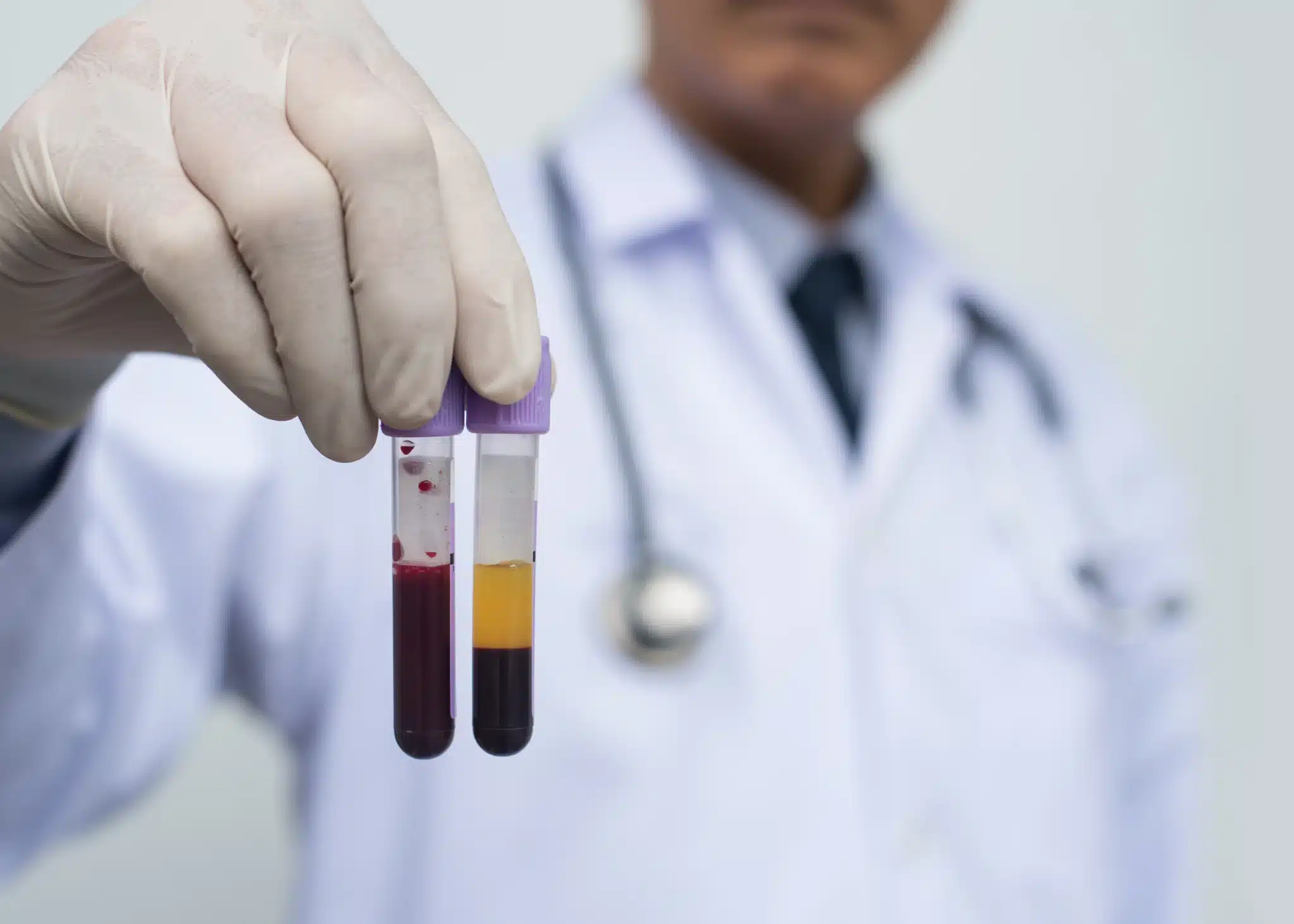 A vial of platelet-rich plasma being prepared in a centrifuge for a PRP and PRF treatment at SpaRx Medical Aesthetics in Thonotosassa, FL.