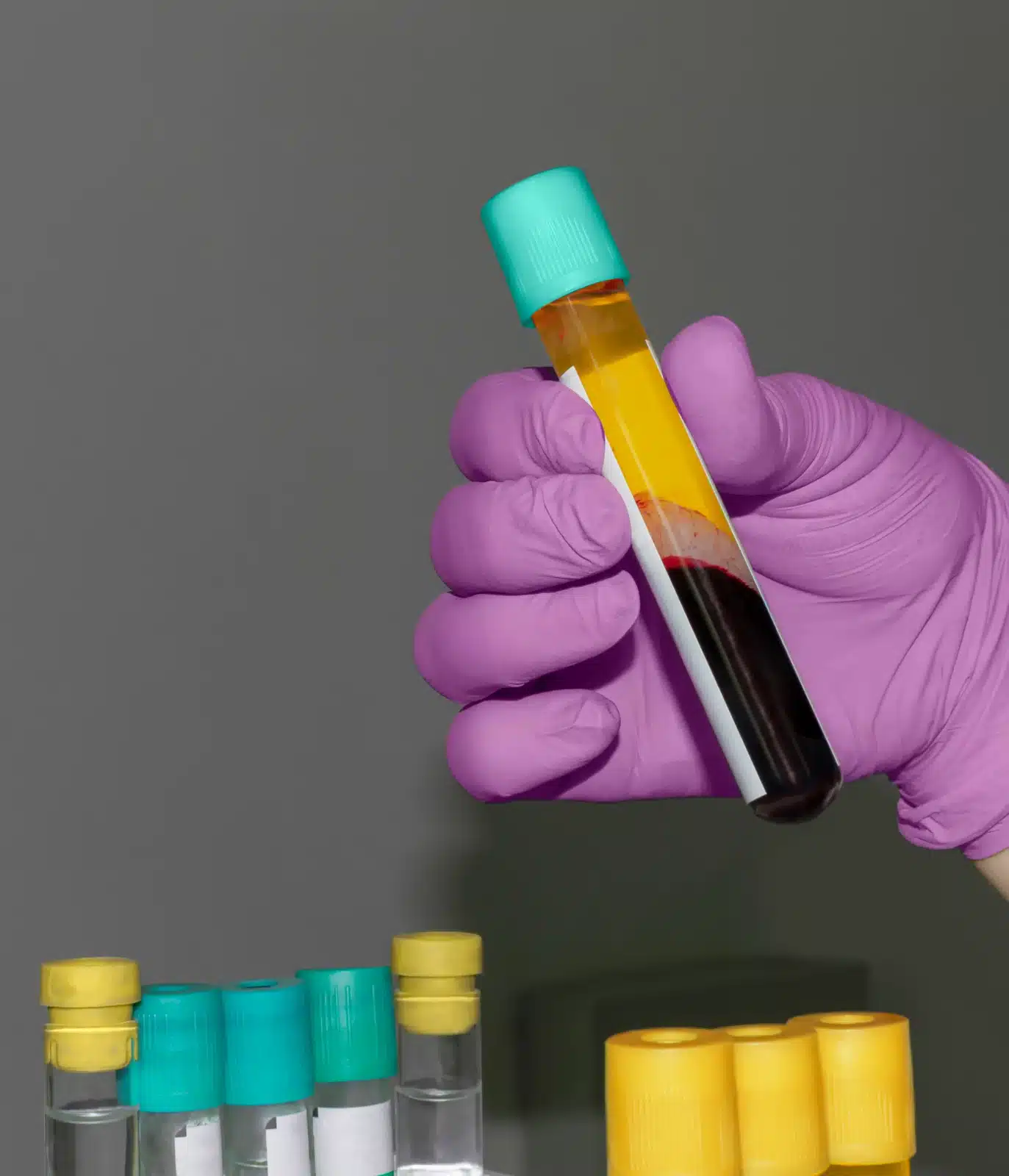 A tube of concentrated plasma prepared in a centrifuge for a PRP or PRF treatment at SpaRx Medical Aesthetics in Thonotosassa, FL