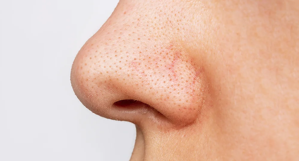 A close-up of enlarged, congested pores that BioRePeel helps refine, at a Thonotosassa, FL medical spa