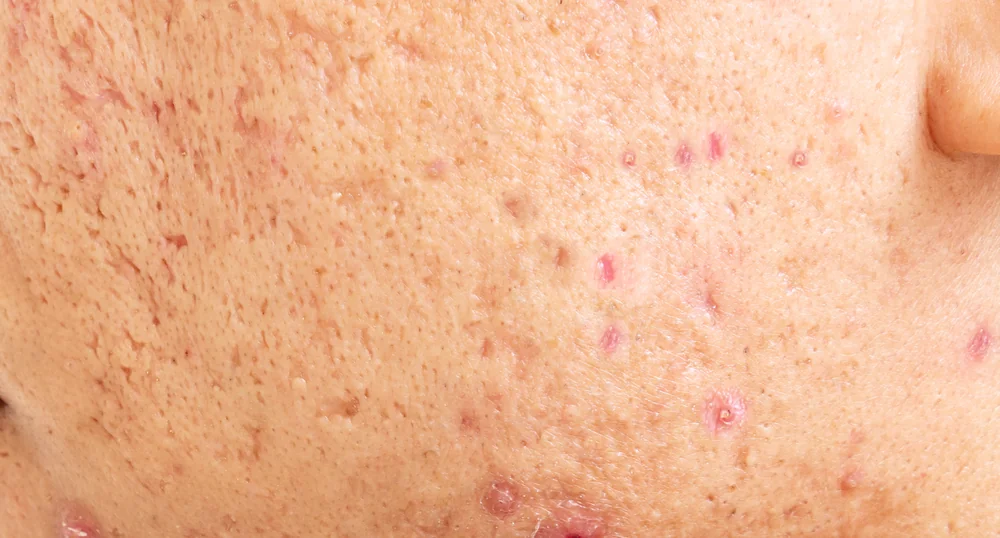 A close-up of acne scarring and uneven texture that a Vampire Facial helps smooth, at a Thonotosassa, FL medical spa