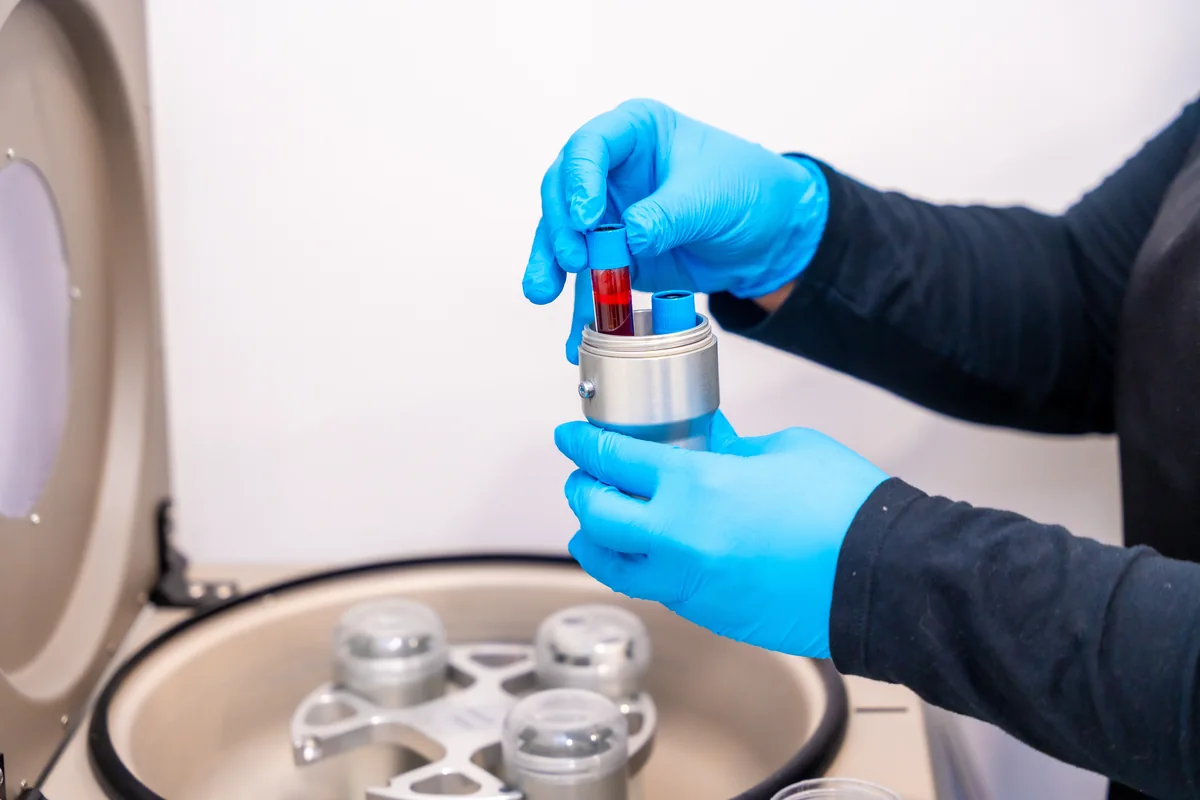A small blood sample drawn and spun into platelet-rich plasma for a Vampire Facial at SpaRx Medical Aesthetics in Thonotosassa, FL
